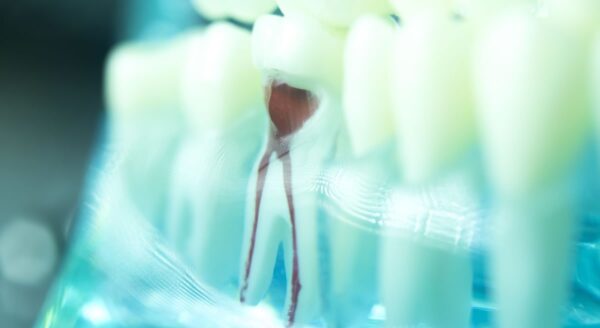 What Is Involved in Root Canal Therapy?
